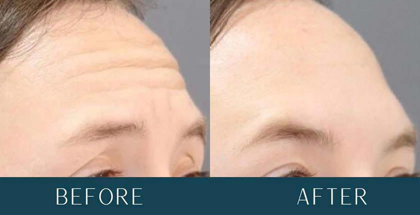 Before and After Treatment Results at Brickell Cosmetic Center in Miami, FL
