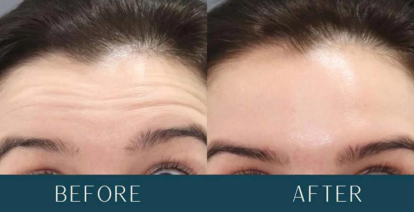 Before and After Treatment Results at Brickell Cosmetic Center in Miami, FL