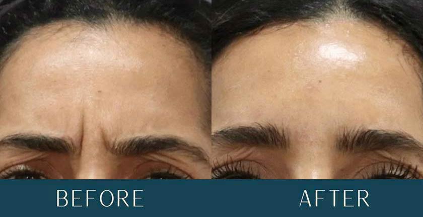 Before and After Treatment Results at Brickell Cosmetic Center in Miami, FL