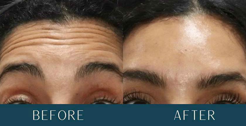Before and After Treatment Results at Brickell Cosmetic Center in Miami, FL