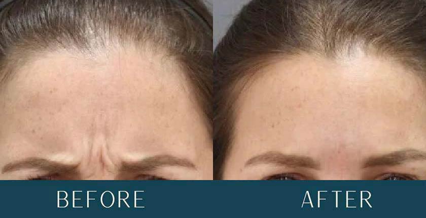 Before and After Treatment Results at Brickell Cosmetic Center in Miami, FL