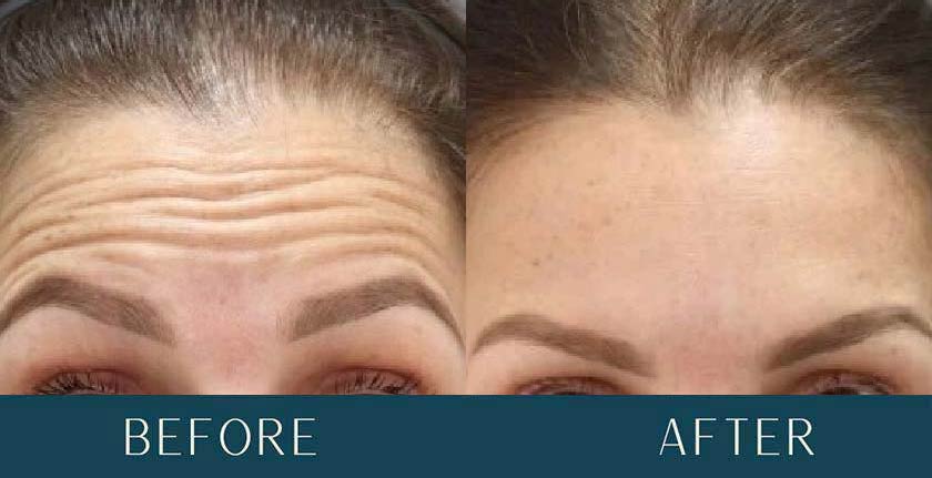 Before and After Treatment Results at Brickell Cosmetic Center in Miami, FL