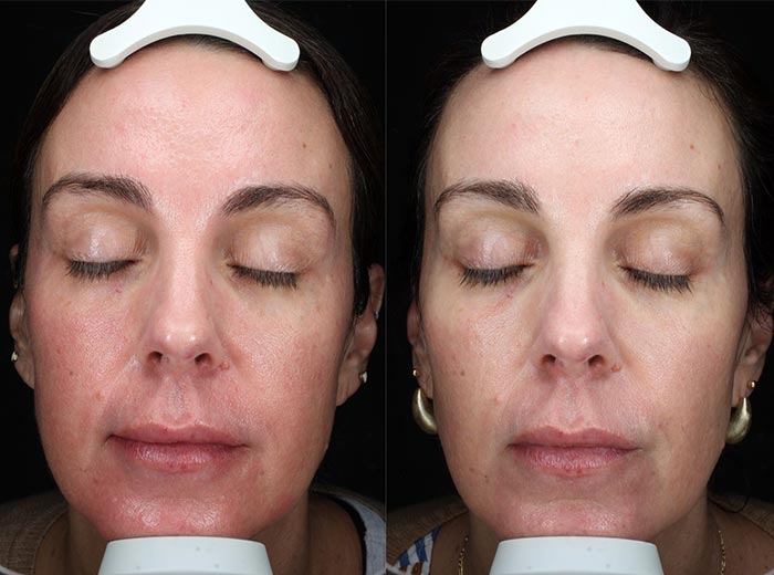Visible Improvement with Clear + Brilliant® at Brickell Cosmetic Center in Miami, FL