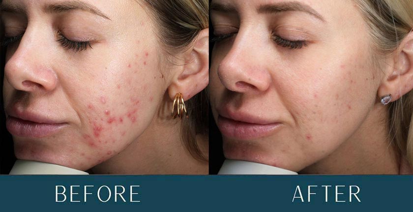 HydraFacial Before and After Treatment Results at Brickell Cosmetic Center in Miami, FL