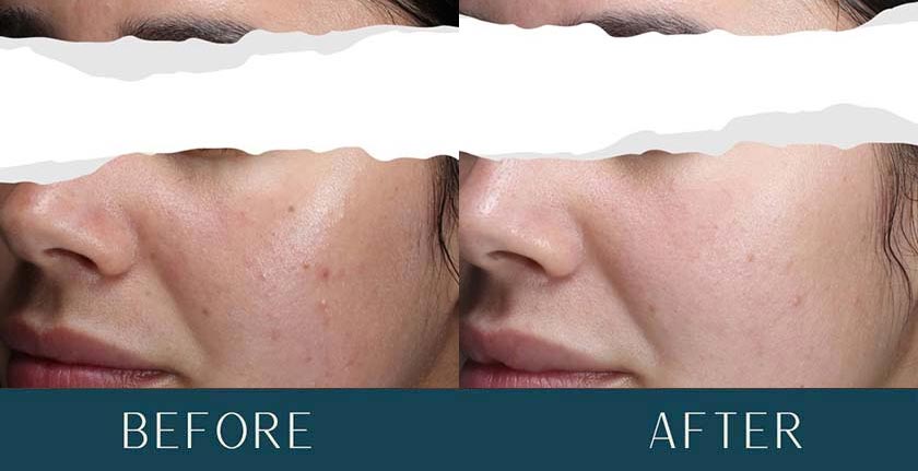 HydraFacial Before and After Treatment Results at Brickell Cosmetic Center in Miami, FL