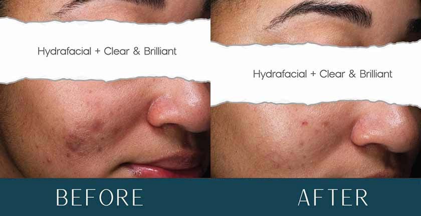 HydraFacial Before and After Treatment Results at Brickell Cosmetic Center in Miami, FL