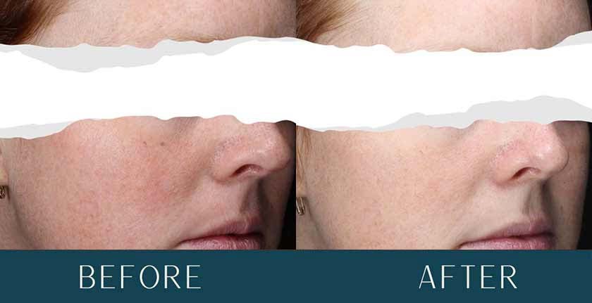 HydraFacial Before and After Treatment Results at Brickell Cosmetic Center in Miami, FL