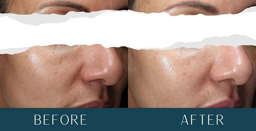 HydraFacial Before and After Treatment Results at Brickell Cosmetic Center in Miami, FL
