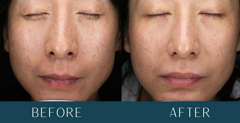 HydraFacial Before and After Treatment Results at Brickell Cosmetic Center in Miami, FL