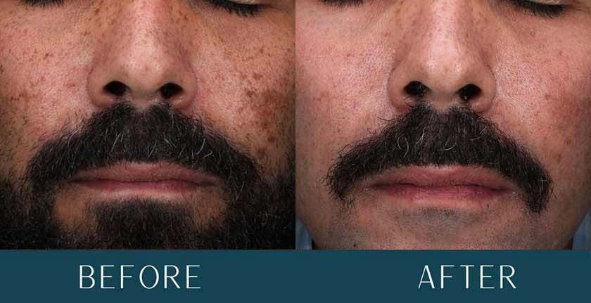 HydraFacial Before and After Treatment Results at Brickell Cosmetic Center in Miami, FL