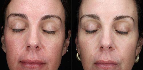 Visible Improvement with Clear + Brilliant® at Brickell Cosmetic Center in Miami, FL