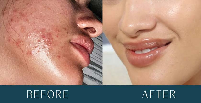 Before and After Treatment Results at Brickell Cosmetic Center in Miami, FL