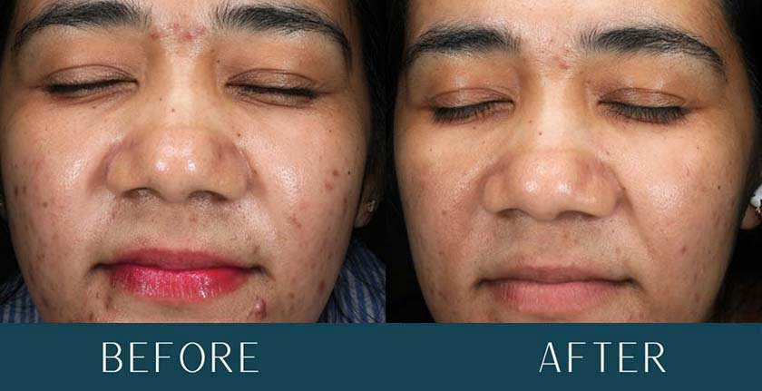 Before and After Treatment Results at Brickell Cosmetic Center in Miami, FL