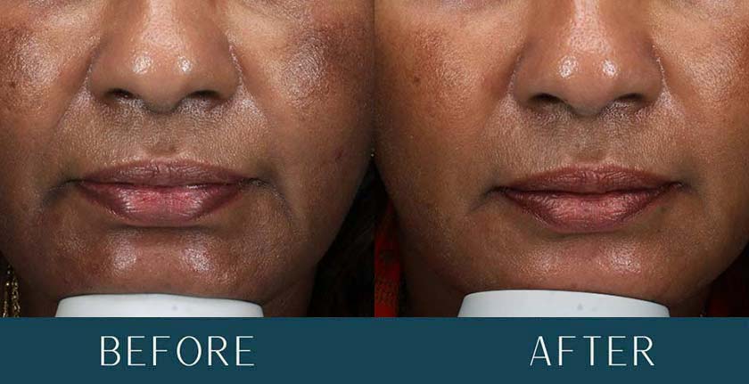 Morpheus8 Treatment Results
