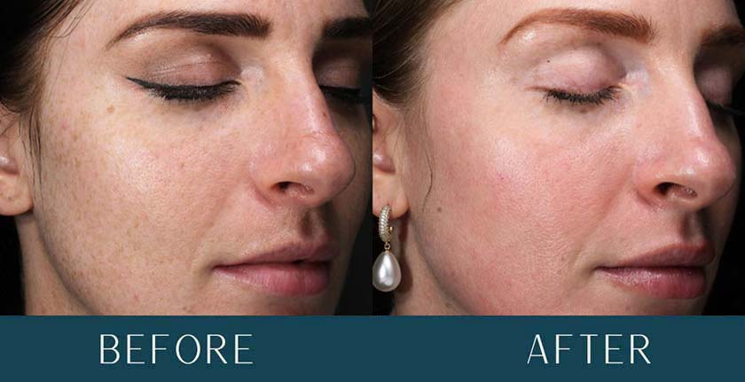 Before and After Treatment Results at Brickell Cosmetic Center in Miami, FL