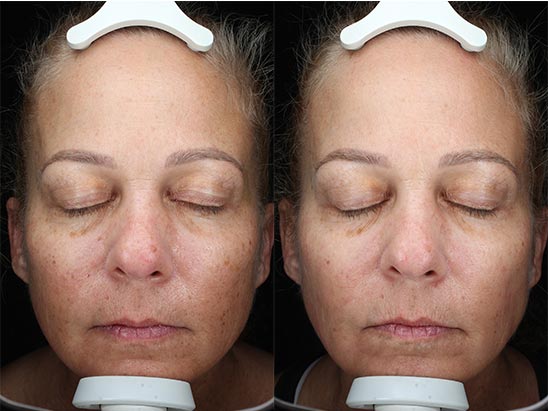 IPL for Progress Toward a More Even Skin Tone at Brickell Cosmetic Center in Miami, FL