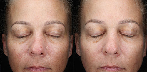 IPL for Progress Toward a More Even Skin Tone at Brickell Cosmetic Center in Miami, FL